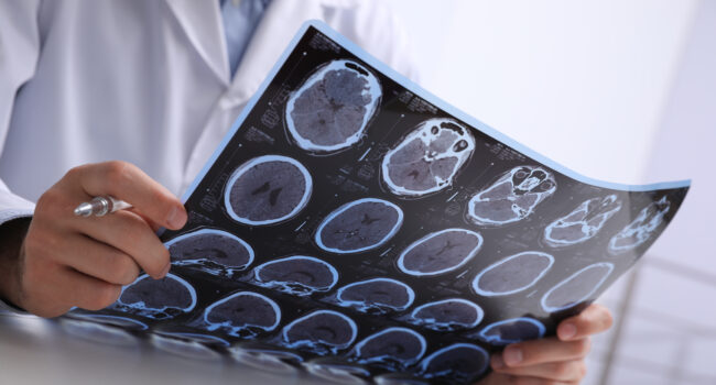image of a doctor examining MRI images of a patient with MS