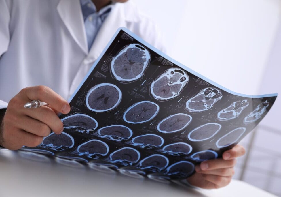 image of a doctor examining MRI images of a patient with MS